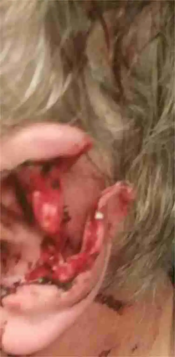 Unbelievable: Man Wakes Up With Half of His Ear Totally Ripped Off... And Has No Clue What Happened